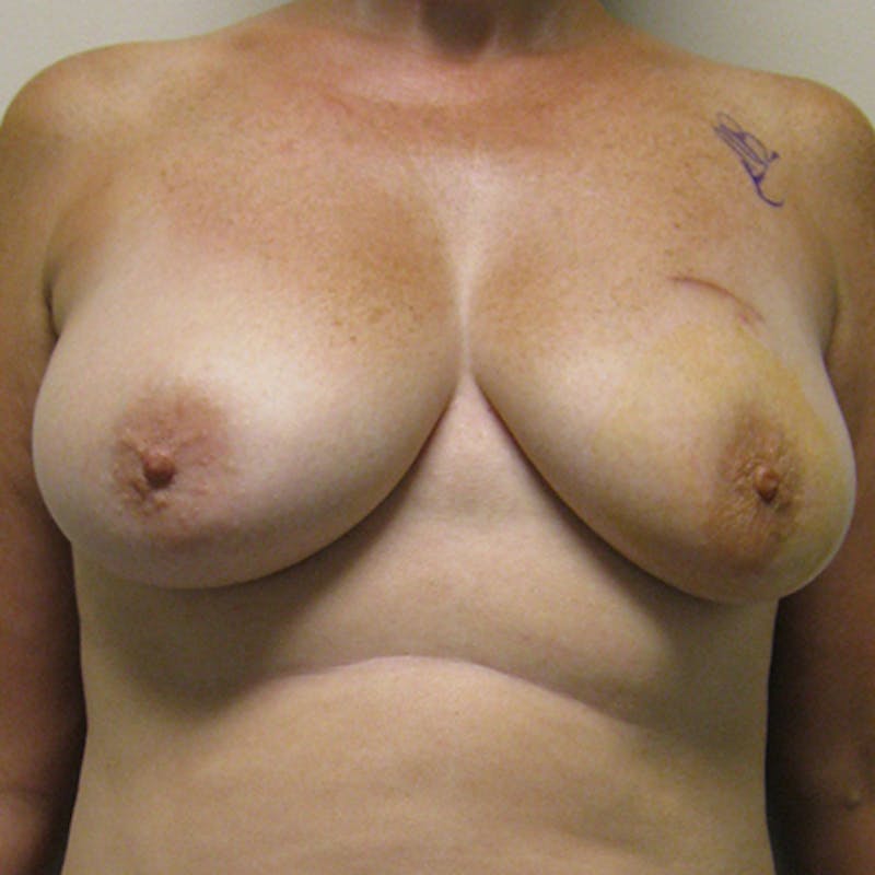 DIEP Flap Reconstruction Before & After Gallery - Patient 154949026 - Image 1