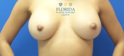 Breast Implant Removal Before & After Gallery - Patient 154949019 - Image 1
