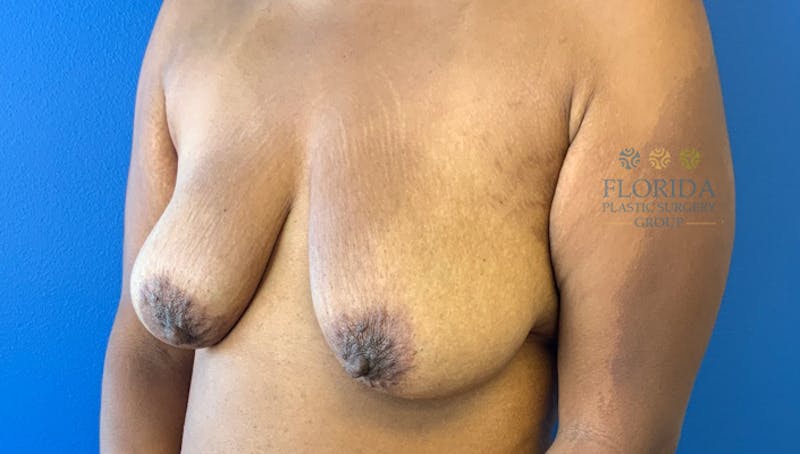 Augmentation Mastopexy Before & After Gallery - Patient 154949023 - Image 3