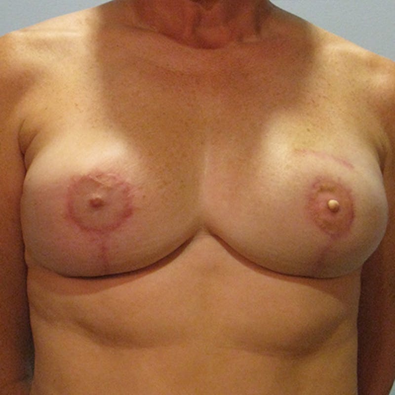 DIEP Flap Reconstruction Before & After Gallery - Patient 154949026 - Image 2