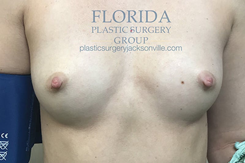 Silicone Breast Augmentation Before & After Gallery - Patient 154949030 - Image 1