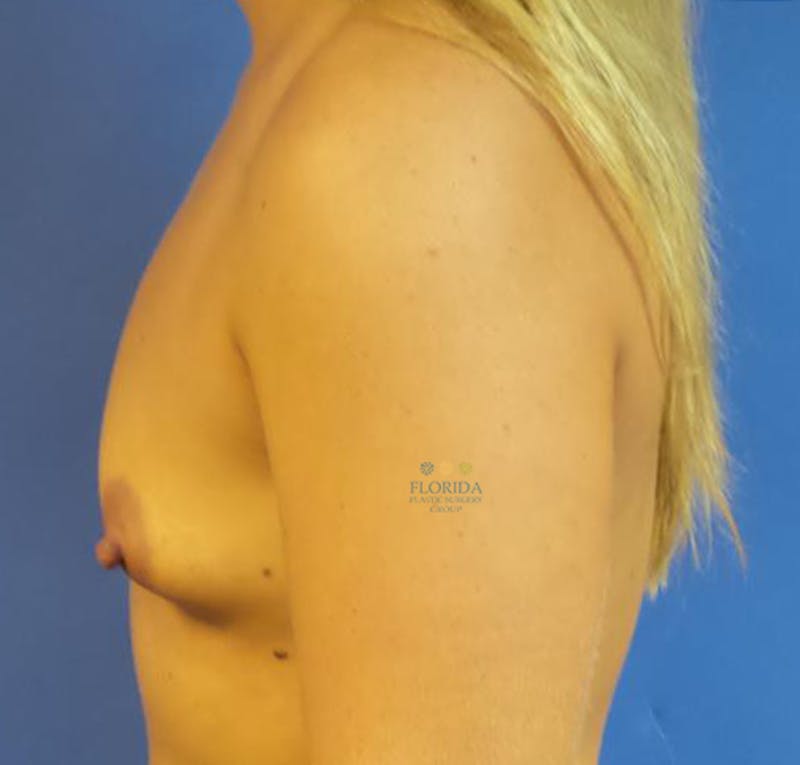 Nipple Sparing Breast Reconstruction Before & After Gallery - Patient 154949020 - Image 3