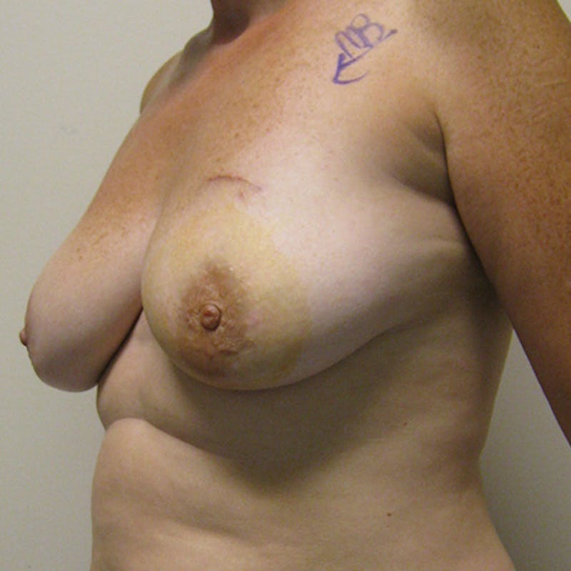DIEP Flap Reconstruction Before & After Gallery - Patient 154949026 - Image 3