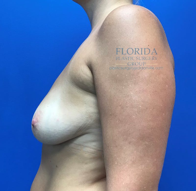 Saline Breast Augmentation Before & After Gallery - Patient 154949021 - Image 5