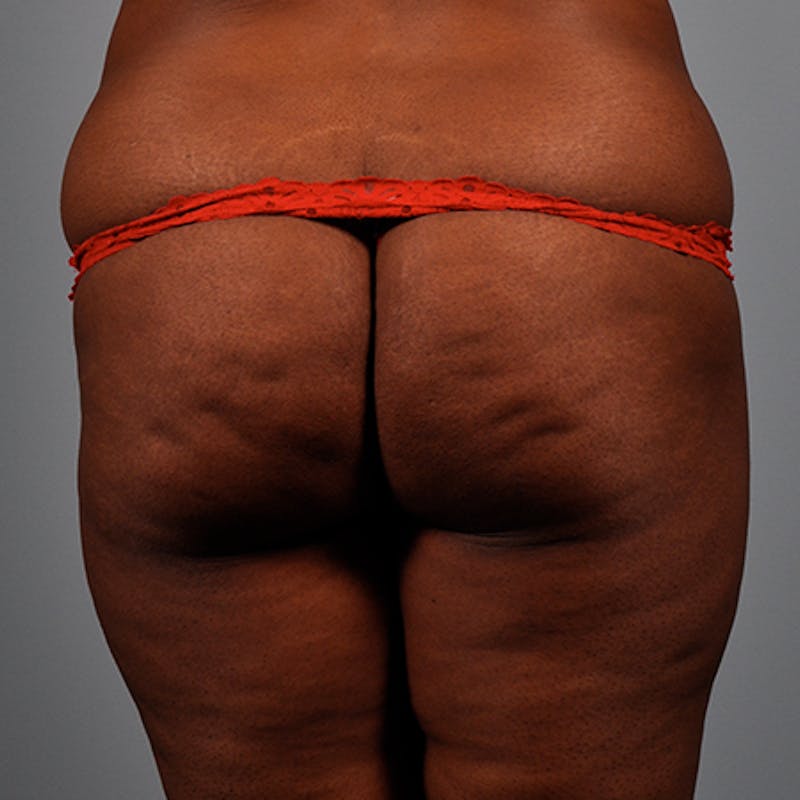 Brazilian Butt Lift Before & After Gallery - Patient 154949034 - Image 1