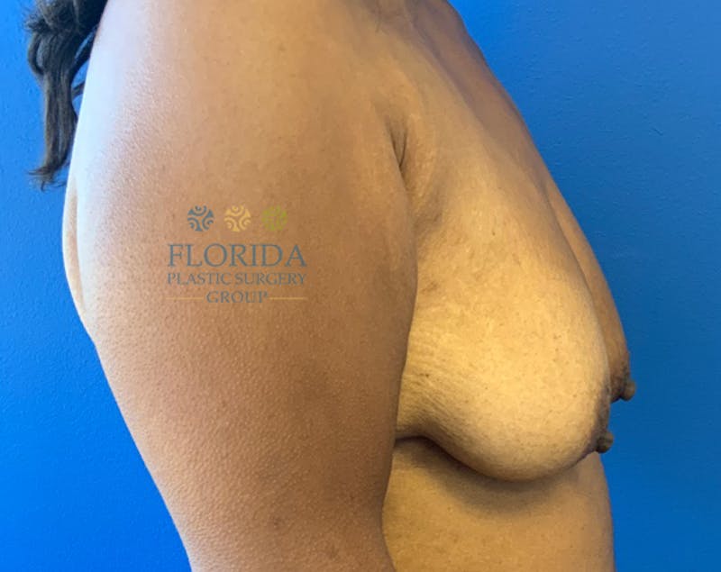 Augmentation Mastopexy Before & After Gallery - Patient 154949023 - Image 5