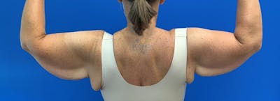 Arm Lift Before & After Gallery - Patient 154949022 - Image 1