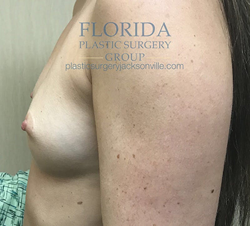 Silicone Breast Augmentation Before & After Gallery - Patient 154949030 - Image 3