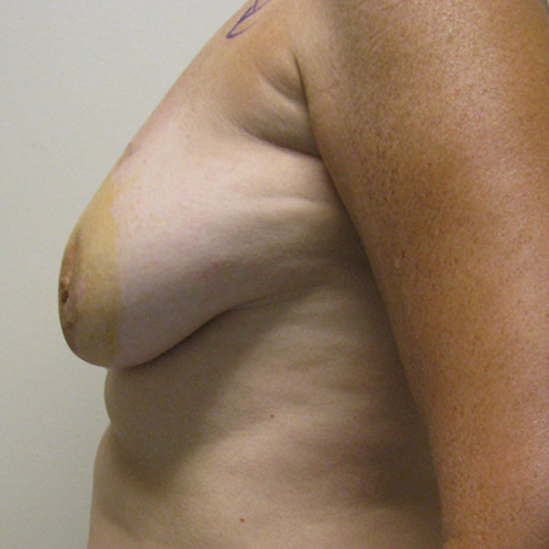 DIEP Flap Reconstruction Before & After Gallery - Patient 154949026 - Image 5