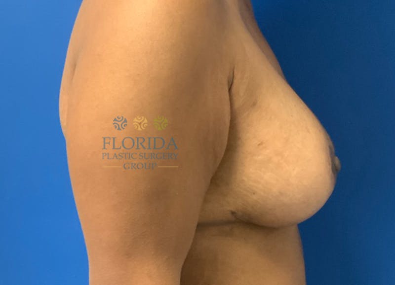 Augmentation Mastopexy Before & After Gallery - Patient 154949023 - Image 6