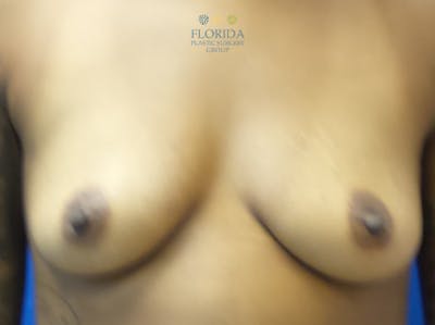 Nipple Sparing Breast Reconstruction Before & After Gallery - Patient 154949032 - Image 1