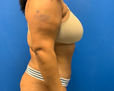 Abdominoplasty Before & After Gallery - Patient 154949036 - Image 2