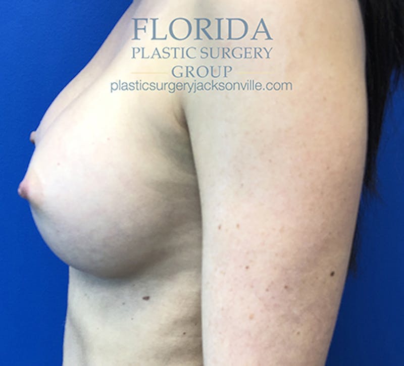 Silicone Breast Augmentation Before & After Gallery - Patient 154949030 - Image 4