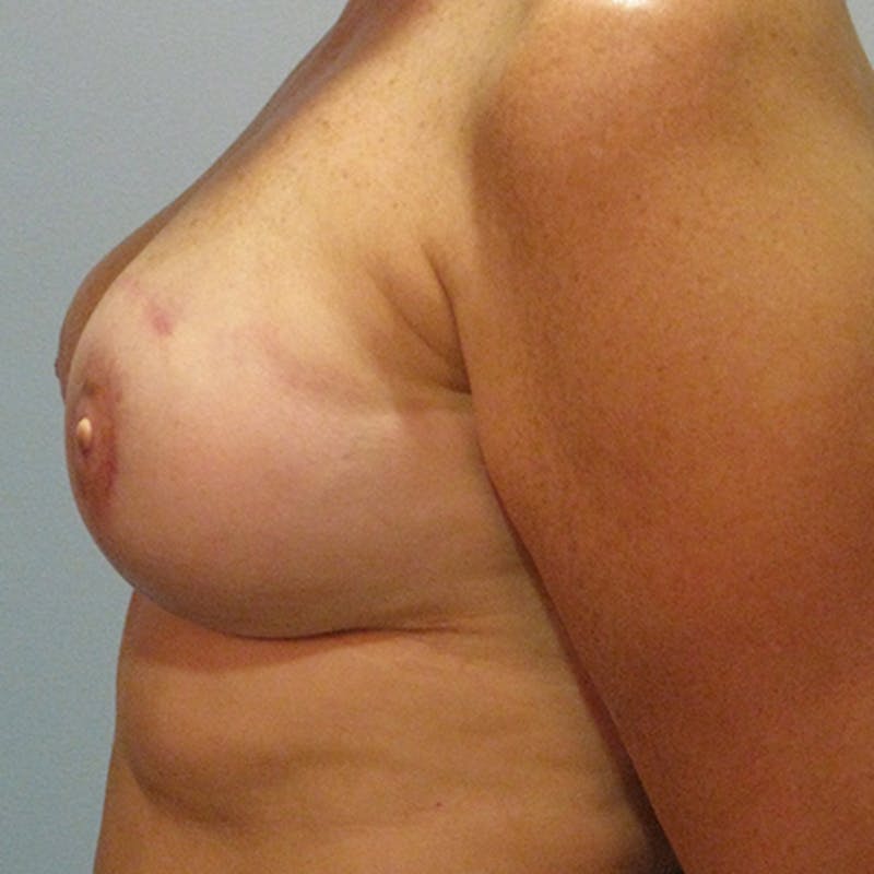 DIEP Flap Reconstruction Before & After Gallery - Patient 154949026 - Image 6