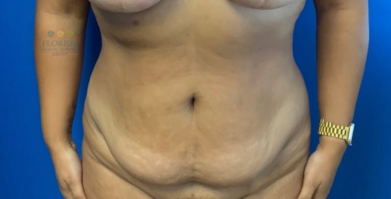 Abdominoplasty Before & After Gallery - Patient 154949036 - Image 3