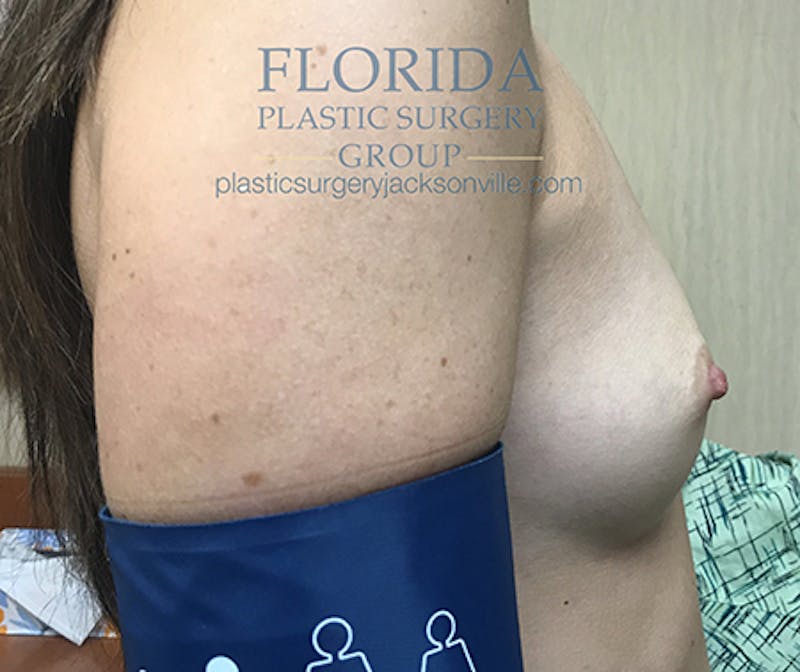 Silicone Breast Augmentation Before & After Gallery - Patient 154949030 - Image 5