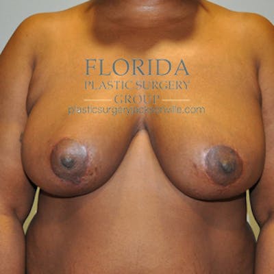 Breast Reduction Before & After Gallery - Patient 154949035 - Image 2