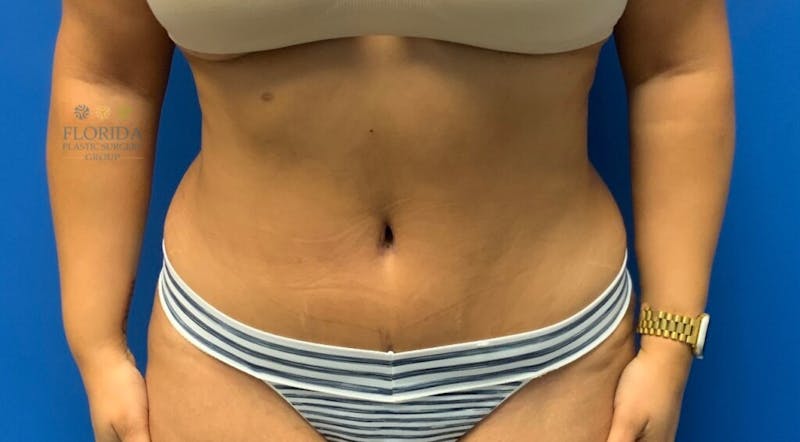 Abdominoplasty Before & After Gallery - Patient 154949036 - Image 4