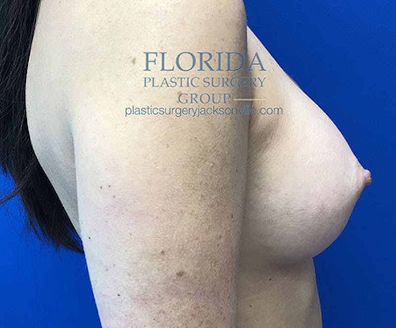 Silicone Breast Augmentation Before & After Gallery - Patient 154949030 - Image 6