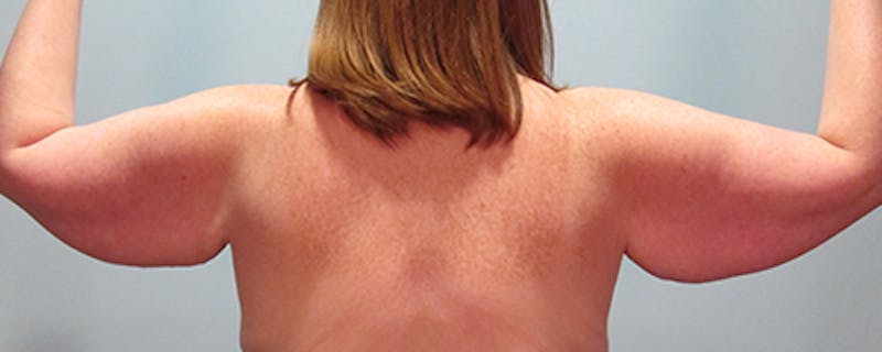 Arm Lift Before & After Gallery - Patient 154949033 - Image 3
