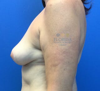 Breast Implant Removal Before & After Gallery - Patient 154949039 - Image 4
