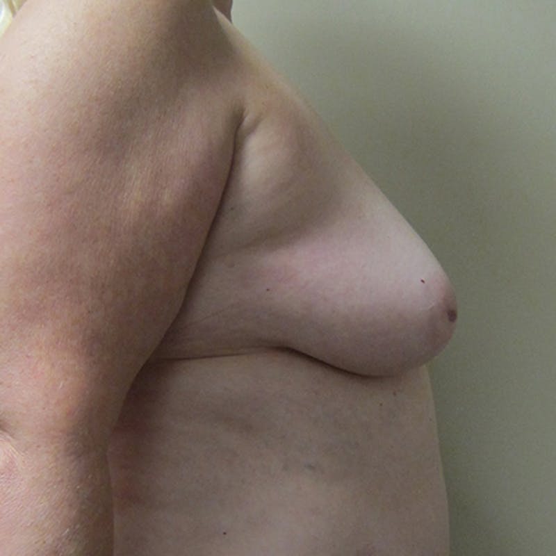 DIEP Flap Reconstruction Before & After Gallery - Patient 154949037 - Image 3