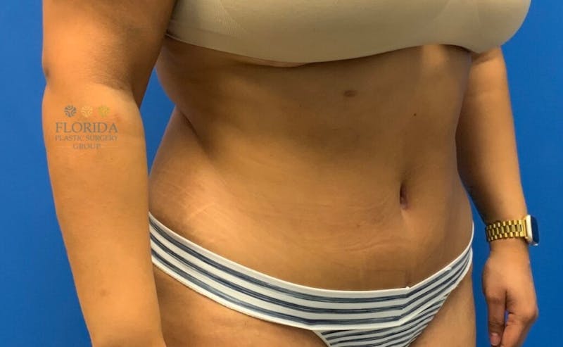 Abdominoplasty Before & After Gallery - Patient 154949036 - Image 6