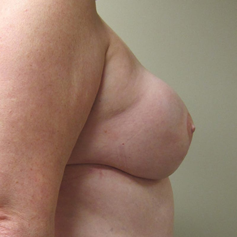 DIEP Flap Reconstruction Before & After Gallery - Patient 154949037 - Image 4