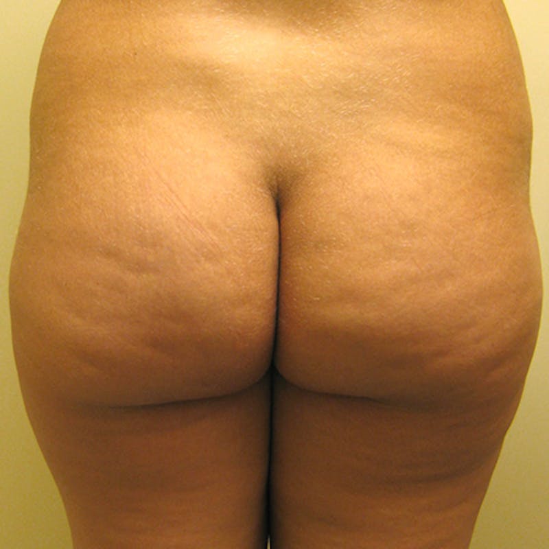 Brazilian Butt Lift Before & After Gallery - Patient 154949054 - Image 1