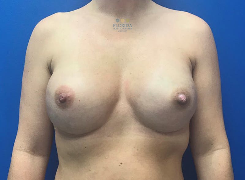 Nipple Sparing Breast Reconstruction Before & After Gallery - Patient 154949052 - Image 2