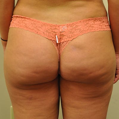 Brazilian Butt Lift Before & After Gallery - Patient 154949054 - Image 2