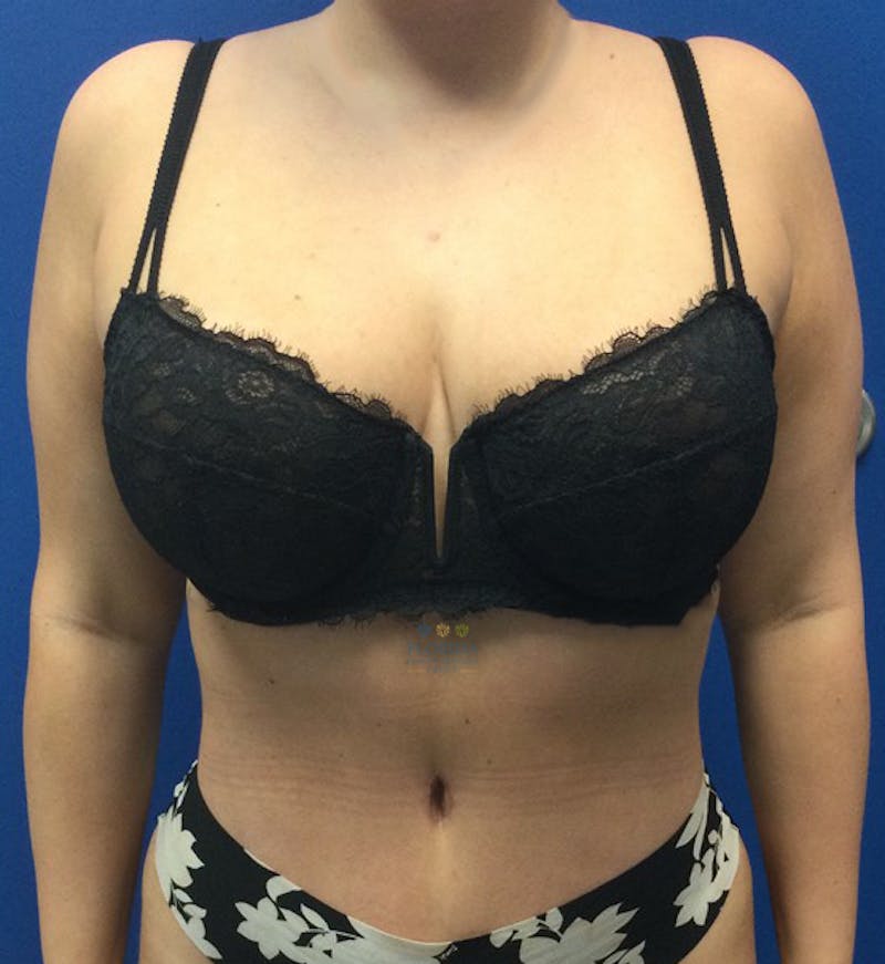 Abdominoplasty Before & After Gallery - Patient 154949046 - Image 2