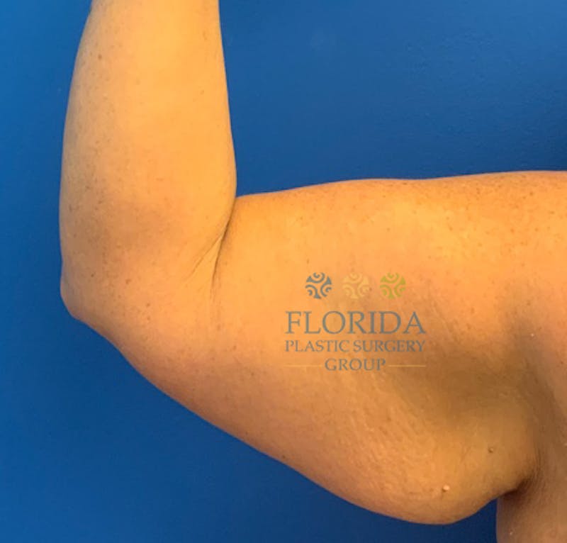 Arm Lift Before & After Gallery - Patient 154949048 - Image 3