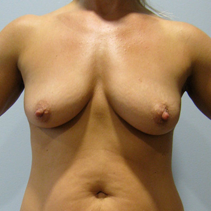 Saline Breast Augmentation Before & After Gallery - Patient 154949053 - Image 1