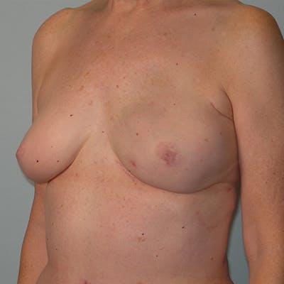 DIEP Flap Reconstruction Before & After Gallery - Patient 154949044 - Image 2