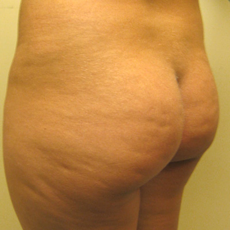Brazilian Butt Lift Before & After Gallery - Patient 154949054 - Image 3