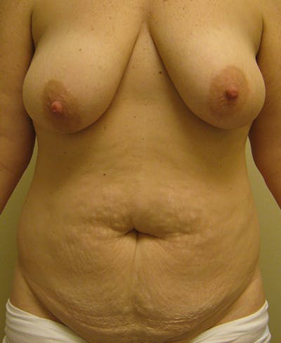 Mommy Makeover Before & After Gallery - Patient 154949067 - Image 1