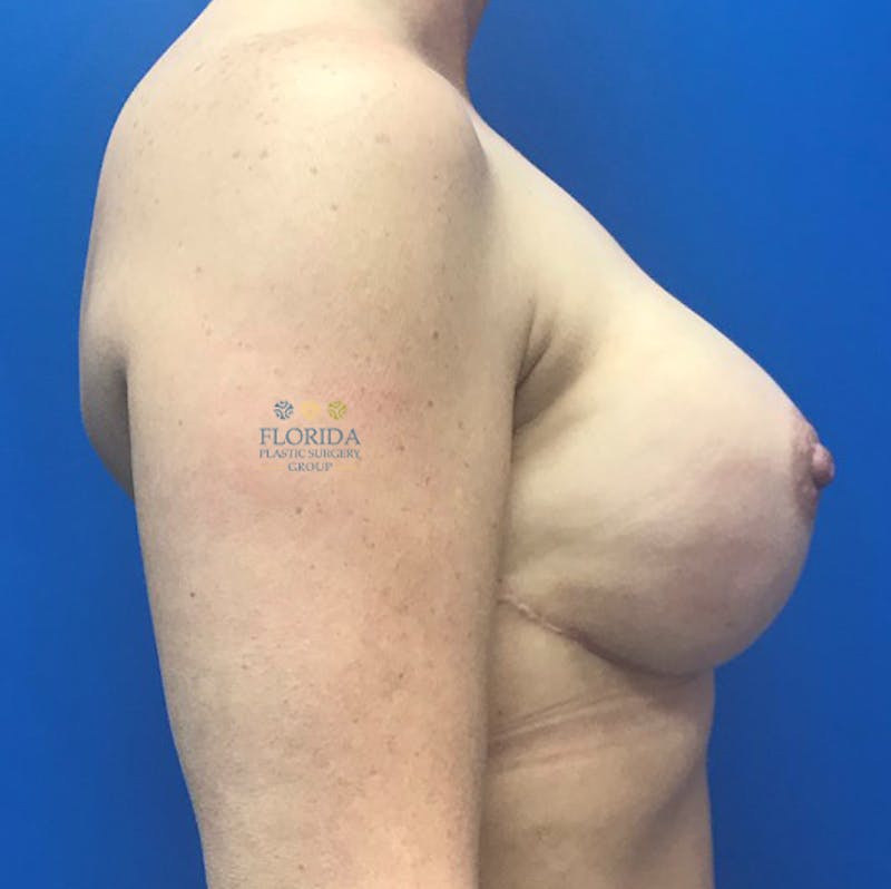Nipple Sparing Breast Reconstruction Before & After Gallery - Patient 154949052 - Image 6