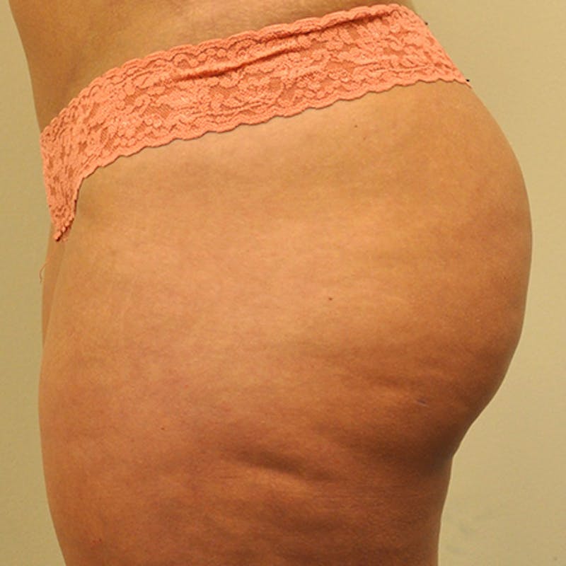 Brazilian Butt Lift Before & After Gallery - Patient 154949054 - Image 6