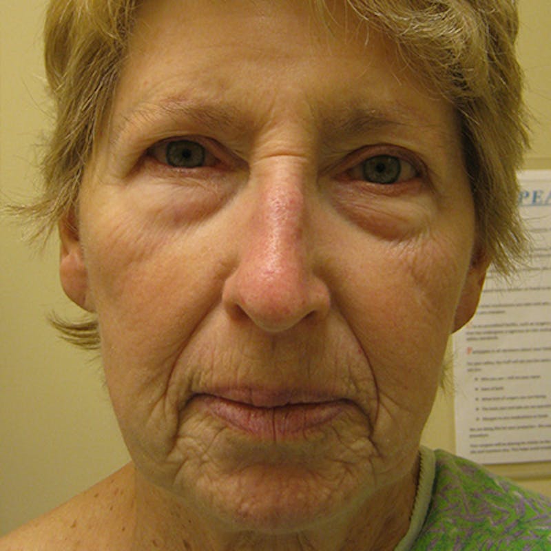 Facial Rejuvenation Before & After Gallery - Patient 154949061 - Image 1