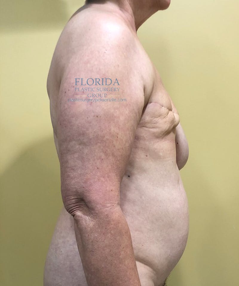 DIEP Flap Reconstruction Before & After Gallery - Patient 154949068 - Image 3