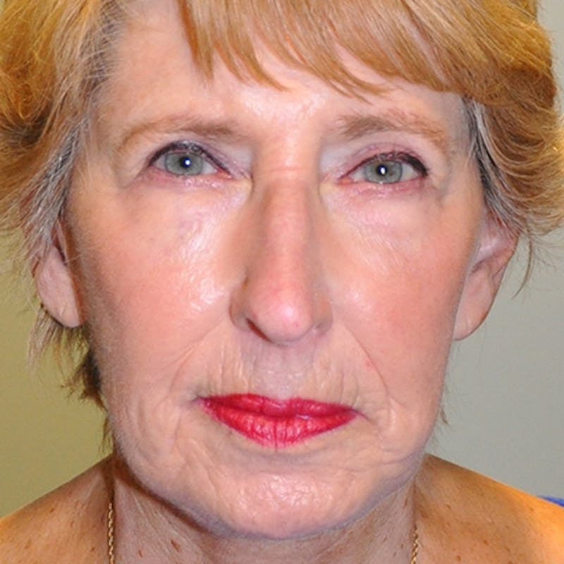 Facial Rejuvenation Before & After Gallery - Patient 154949061 - Image 2