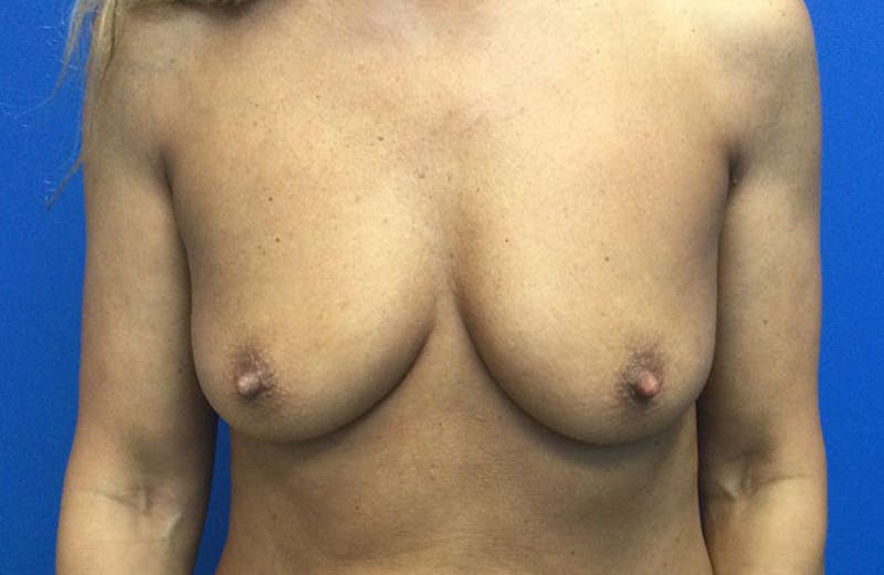 Saline Breast Augmentation Before & After Gallery - Patient 154949057 - Image 1