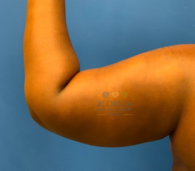 Arm Lift Before & After Gallery - Patient 154949058 - Image 4