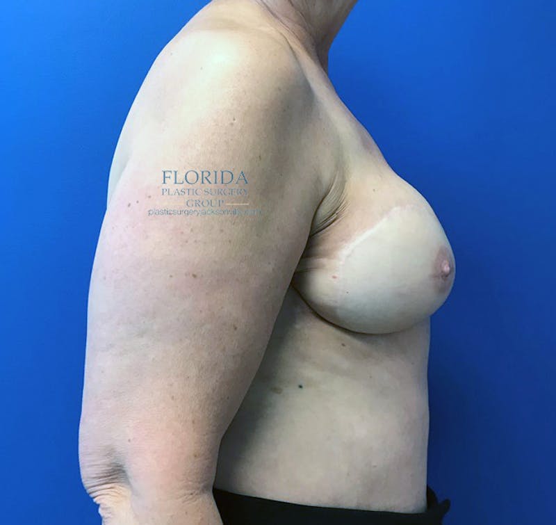 DIEP Flap Reconstruction Before & After Gallery - Patient 154949068 - Image 4