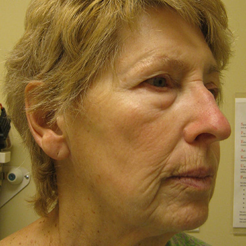 Facial Rejuvenation Before & After Gallery - Patient 154949061 - Image 3
