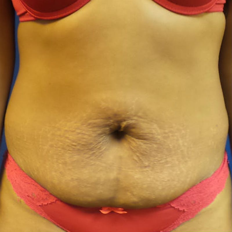 Abdominoplasty Before & After Gallery - Patient 154949070 - Image 1