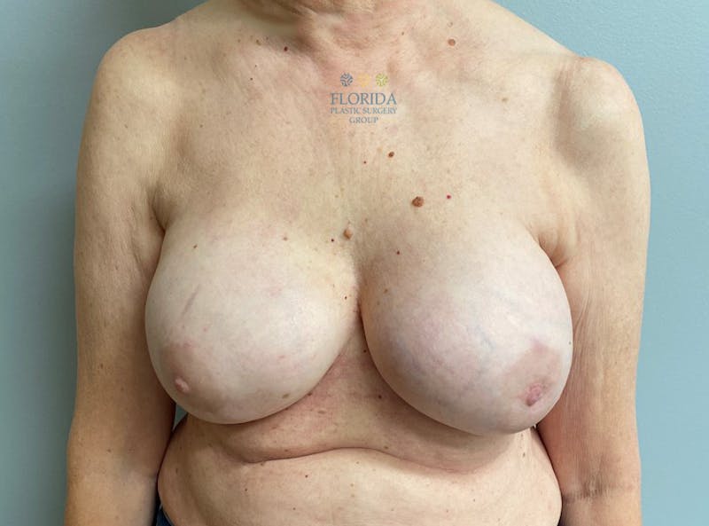 Nipple Sparing Breast Reconstruction Before & After Gallery - Patient 154949069 - Image 2
