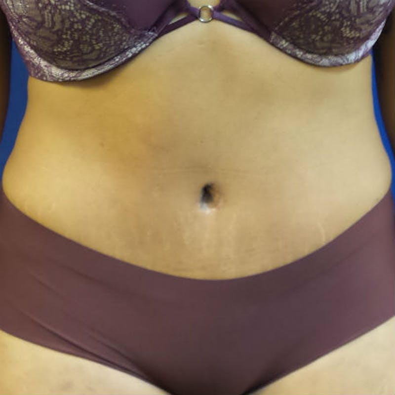 Abdominoplasty Before & After Gallery - Patient 154949070 - Image 2