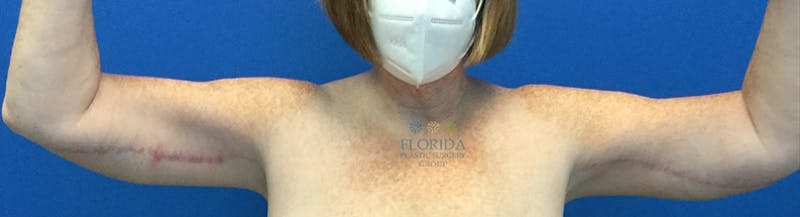 Arm Lift Before & After Gallery - Patient 154949072 - Image 2